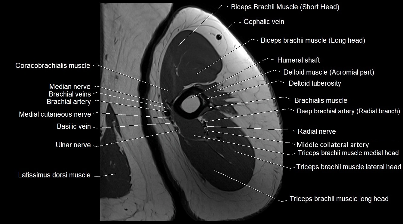 Upper arm( humerus) cross section anatomy MRI 3T axial image 29.webp